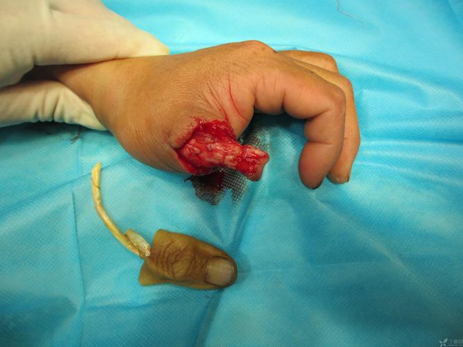 小萨遭遇拇指韧带撕脱性骨折